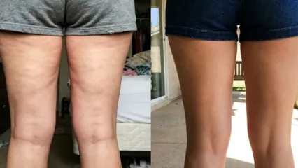 Before and after photos shared by a MyoGlow customer showing the backs of her legs