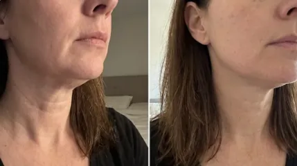 Before and after photos shared by a MyoGlow customer showing her neck and jawline